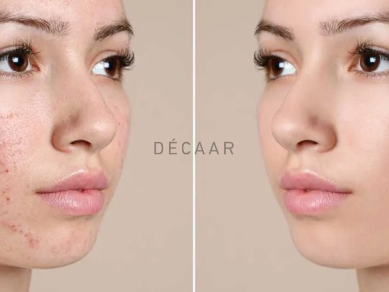 peel da trị mụn